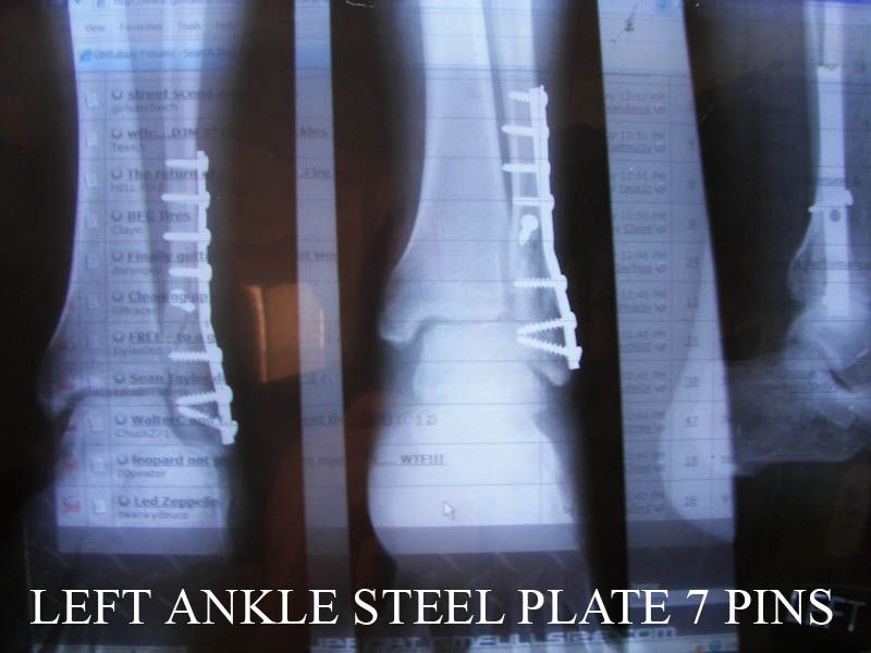 ANKLE.jpg